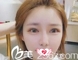 恢复18天的双眼皮已经消肿 恢复18天的双眼皮已经消肿