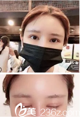 切开双眼皮术后7天拆线后眼睛微肿 切开双眼皮术后7天拆线后眼睛微肿