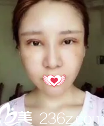 术后第二天眼睛肿胀 术后第二天眼睛肿胀