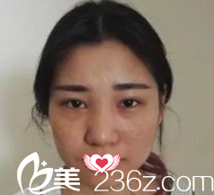 术前双眼皮失败导致两边不对称 术前双眼皮失败导致两边不对称