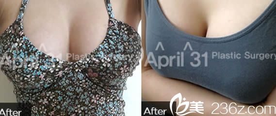 在韩国排名前十的整形医院4月31日整形外科做自体脂肪隆胸的真实分享