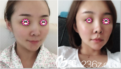 北京美莱宋延刚面部脂肪填充案例