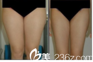 北京美莱宋延刚医生腿部吸脂案例