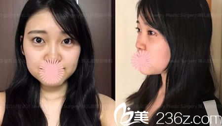 韩国珠儿丽整形外科的术前照 韩国珠儿丽整形外科的术前照