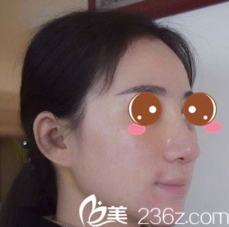 有人询问郑州百荟做隆鼻技术咋样 我用亲身隆鼻经历告诉你大鼻头不见了有多美