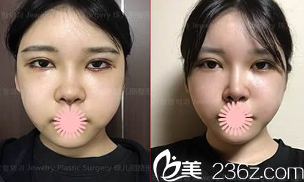 韩国珠儿丽整形外科做双眼皮和颧骨缩小及下巴整形恢复照