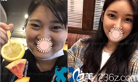 做双眼皮+颧骨缩小术+下巴整形手术后和术前的对比照 做双眼皮+颧骨缩小术+下巴整形手术后和术前的对比照