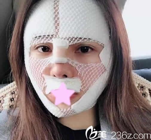 我在运城丽都整形做面部自体脂肪填充手术当天