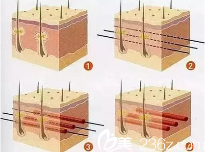 <!--<i data=20240703-sp></i>-->三维分区复位线雕术 <!--<i data=20240703-sp></i>-->三维分区复位线雕术