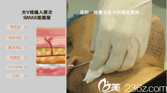 线雕植入过程 线雕植入过程