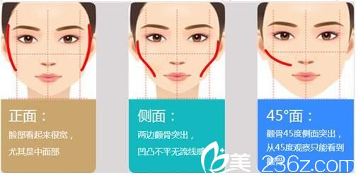 磨颧骨手术原理