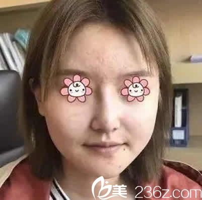 我在运城华美整形医院做面部线雕前的照片 我在运城华美整形医院做面部线雕前的照片