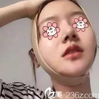 我在运城华美整形做全脸线雕提升后第3天照片 我在运城华美整形做全脸线雕提升后第3天照片