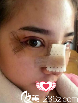 做完眼鼻综合第2天很肿胀