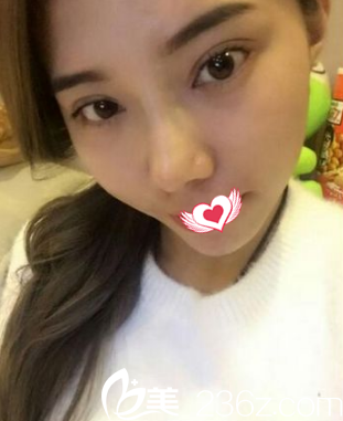 术后16天双眼皮和鼻子慢慢消肿