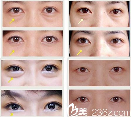 驻马店美兰德去眼袋案例