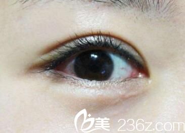 大连做埋线法双眼皮价格多少钱？