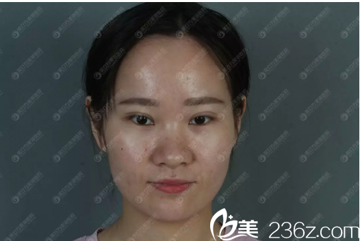 在东莞美立方做隆鼻手术前 在东莞美立方做隆鼻手术前