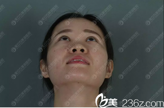 隆鼻术前仰视图 隆鼻术前仰视图