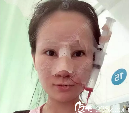 东莞美立方郑志敏隆鼻手术天 东莞美立方郑志敏隆鼻手术天