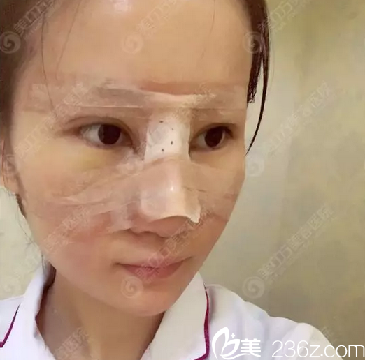 东莞美立方郑志敏隆鼻手术第三天 东莞美立方郑志敏隆鼻手术第三天