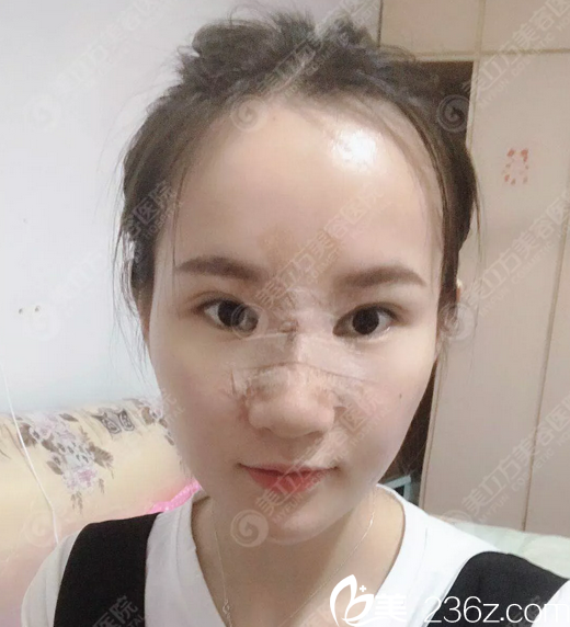 东莞美立方郑志敏隆鼻术后7天照片 东莞美立方郑志敏隆鼻术后7天照片