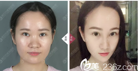 东莞美立方郑志敏隆鼻案例对比图 东莞美立方郑志敏隆鼻案例对比图