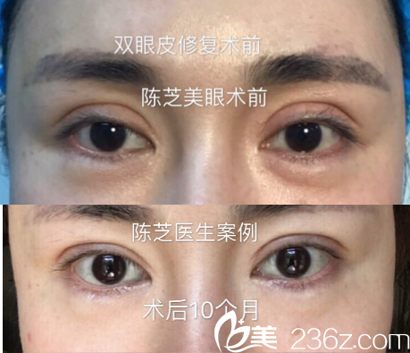 深圳美莱陈芝医生做的双眼皮失败修复案例对比图片
