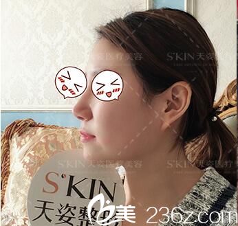 在天姿做鼻综合术后30天<span style=