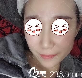 在天姿整形医院做鼻综合术后60天恢复情况