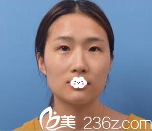 随州奥莱双眼皮真人案例 随州奥莱双眼皮真人案例