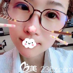 随州奥莱双眼皮+开眼角术后效果 随州奥莱双眼皮+开眼角术后效果