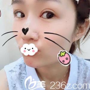 随州奥莱割双眼皮+开内眼角术后恢复过程图 随州奥莱割双眼皮+开内眼角术后恢复过程图