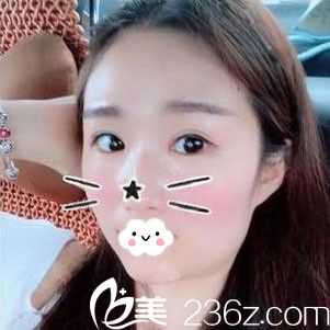 假期我到随州奥莱医疗美容张志田处做双眼皮+开眼角整形了