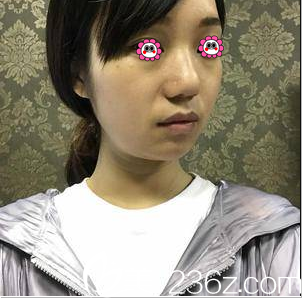 在北京华韩做热玛吉美肤前样子 在北京华韩做热玛吉美肤前样子