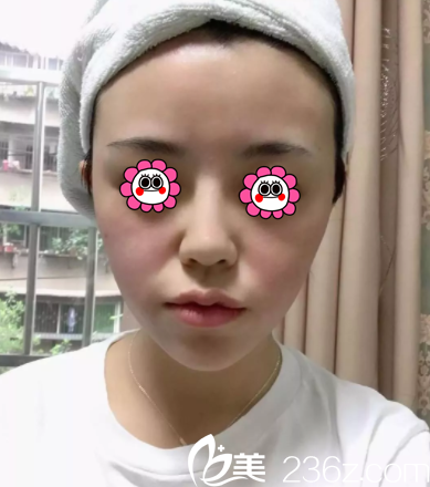 北京华韩热玛吉美肤案例 北京华韩热玛吉美肤案例