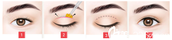 金圣训医生切开双眼皮的手术方法 金圣训医生切开双眼皮的手术方法