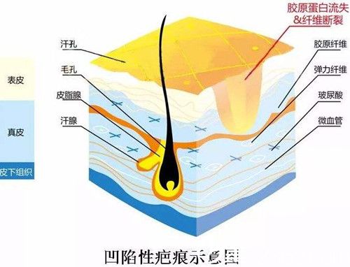 凹陷性疤痕特点