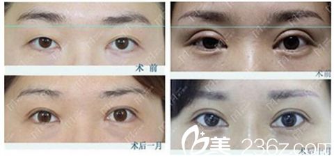 郑州孔宇院长做双眼皮修复案例