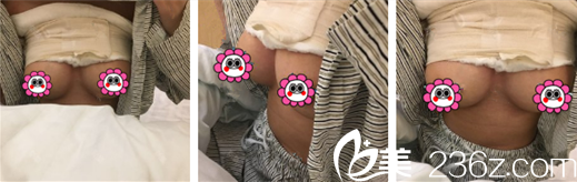 假体丰胸术后第二天 假体丰胸术后第二天