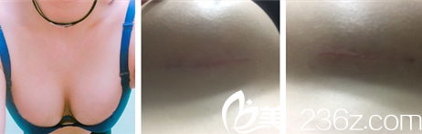 赵镕贤医生假体丰胸恢复10天 赵镕贤医生假体丰胸恢复10天