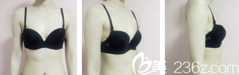 术前胸部干瘪扁平 术前胸部干瘪扁平