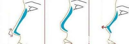 在南昌做假体隆鼻手术多少钱 在南昌做假体隆鼻手术多少钱