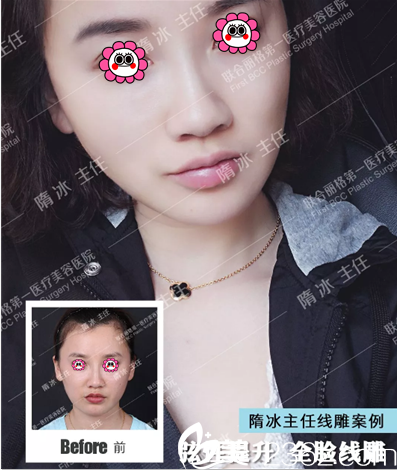 北京联合丽格弦性提升全脸线雕案例