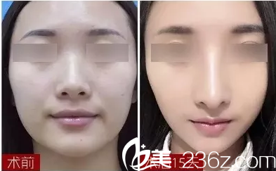 <!--<i data=20240703-sp></li>
<li><i data=20240703-sp></i>-->医生隆鼻真人案例前后对比