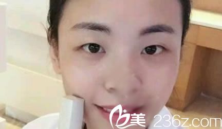 在黄岩昊阳整形割双眼皮前 在黄岩昊阳整形割双眼皮前