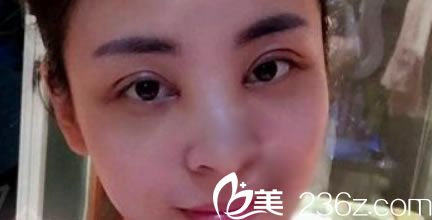 在黄岩昊阳做双眼皮当天效果 在黄岩昊阳做双眼皮当天效果