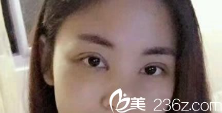 做完双眼皮和开眼角5天恢复照 做完双眼皮和开眼角5天恢复照