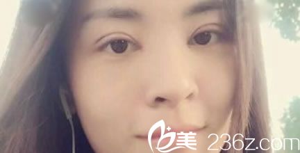 台州黄岩昊阳整形做双眼皮效果怎么样,国庆刚找他割双眼皮开眼角了