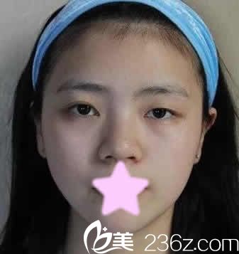 我找长治悦美整形薛艳峰做眼部综合整形前照片 我找长治悦美整形薛艳峰做眼部综合整形前照片